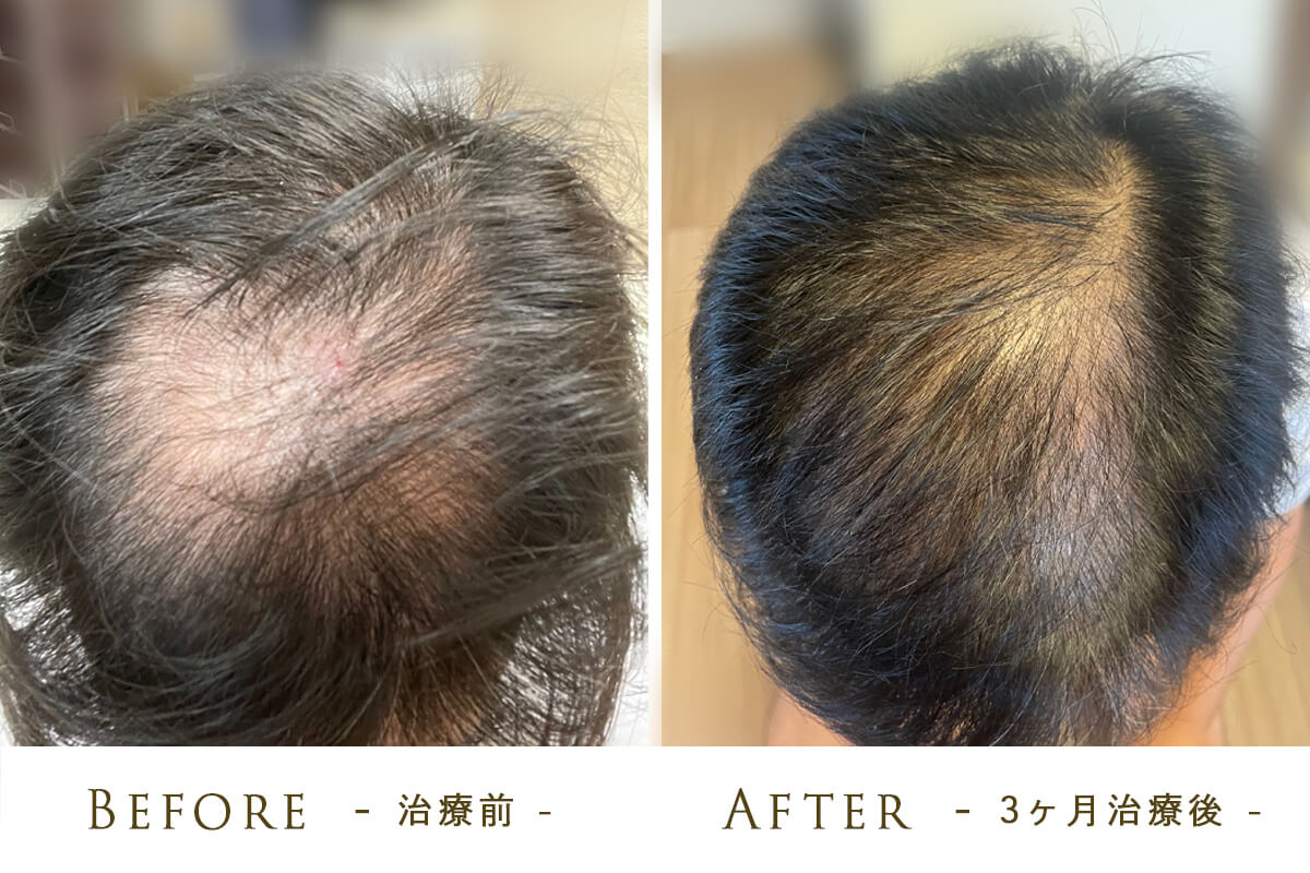 幹細胞で毛髪再生