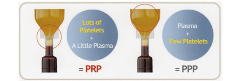 PRPとは