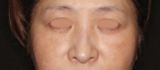 術後