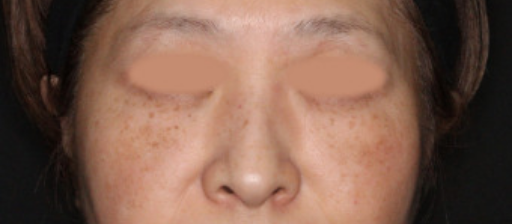 術前