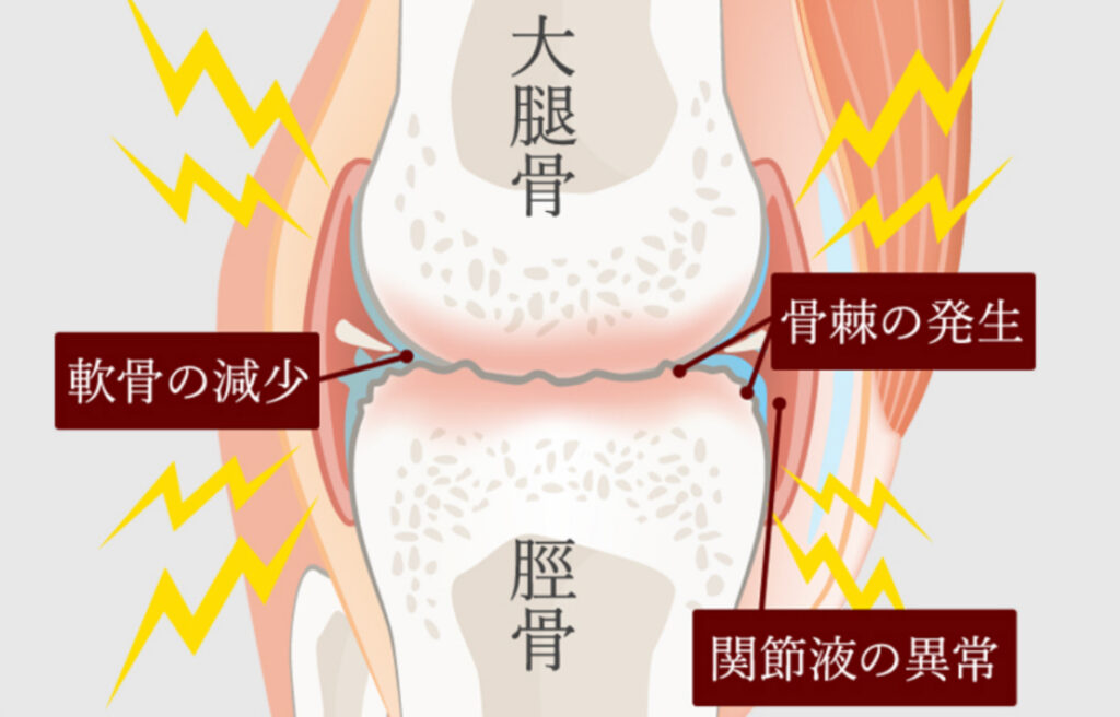 変形性膝関節症